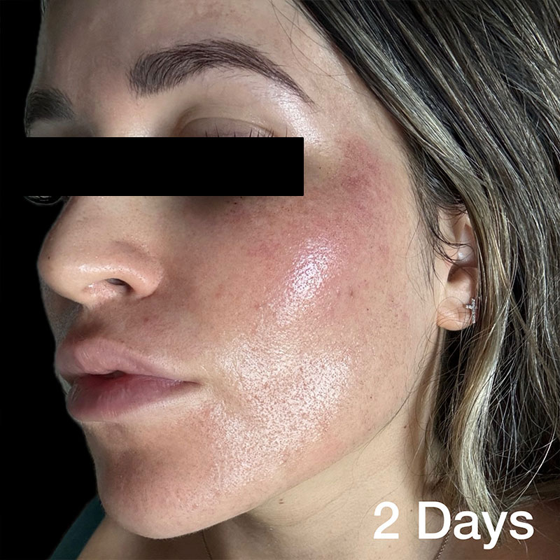 coolpeel-2-days-a