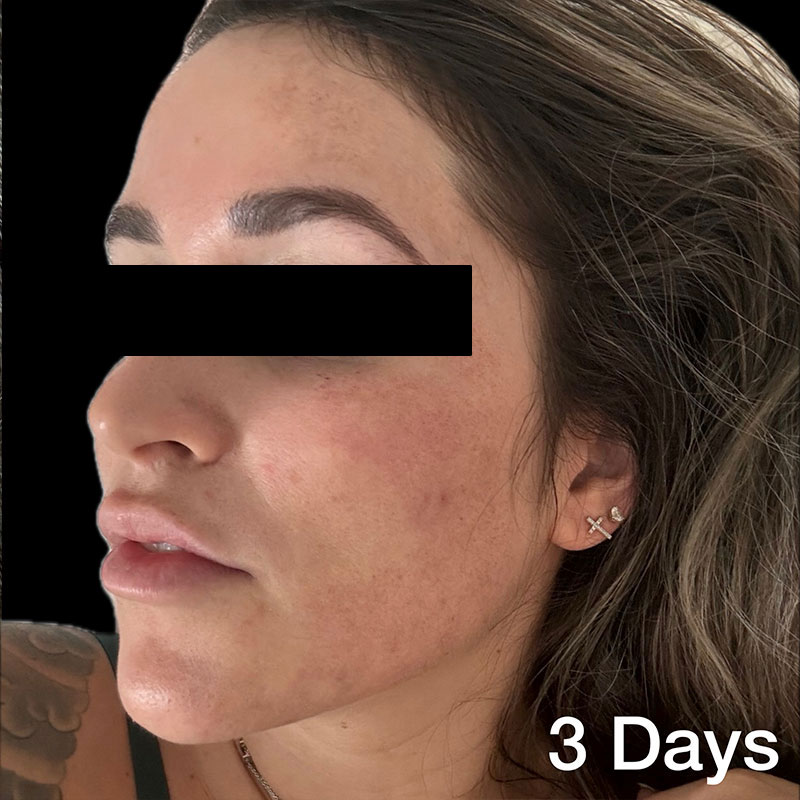 coolpeel-3-days-a