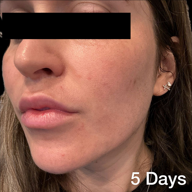 coolpeel-5-days-a