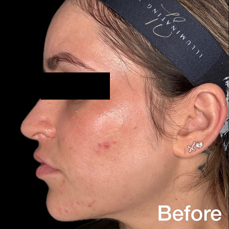 coolpeel-before-a